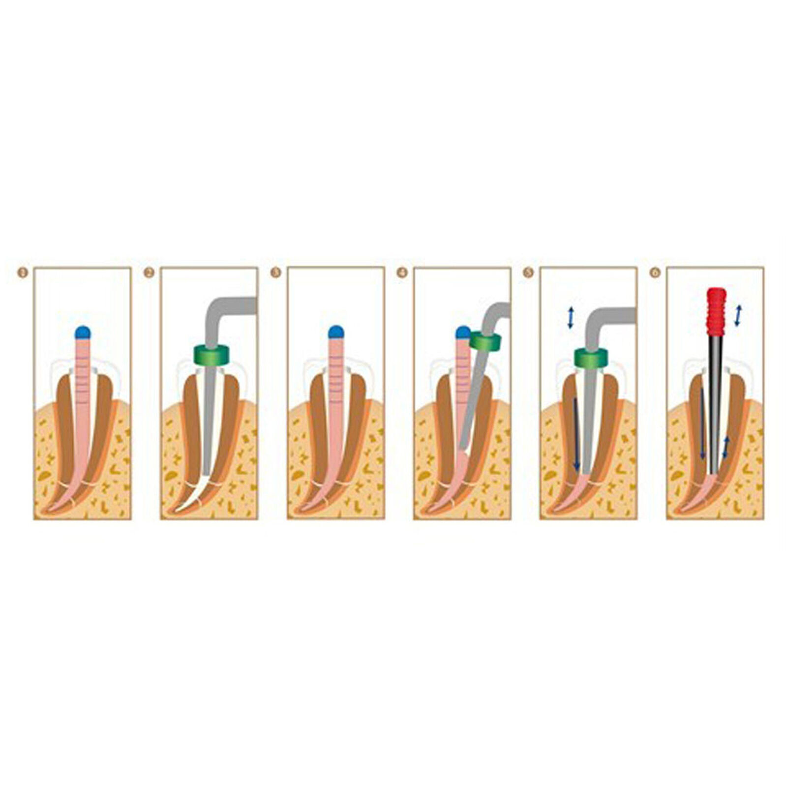 ORIGINAL Kerr Sybron Endo Elements Buchanan System B Heat Plugger Obturation Tip