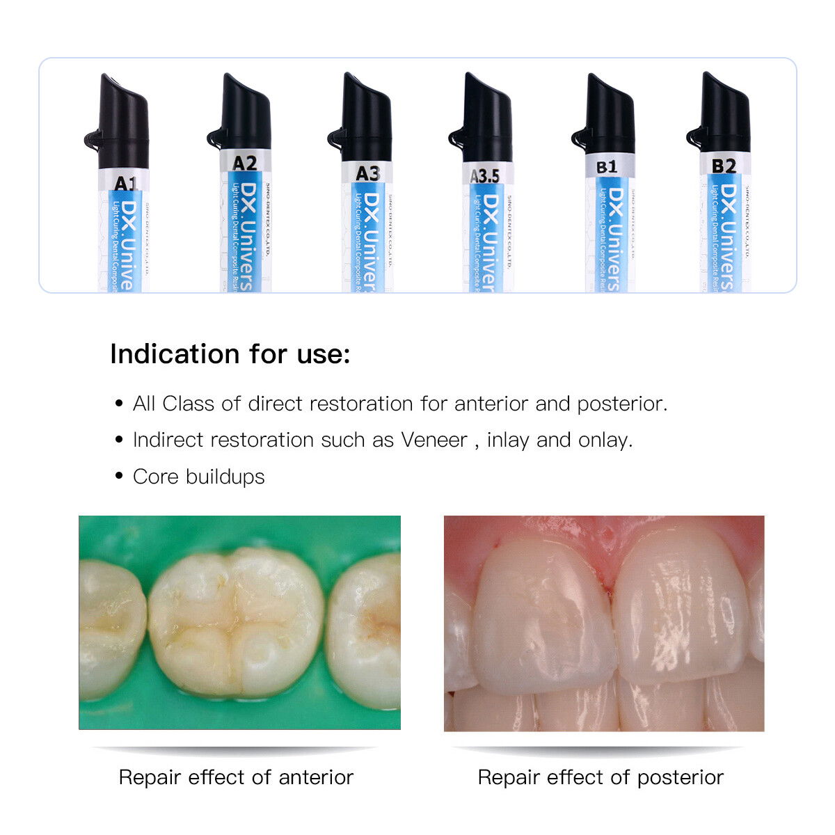 Dentex Dental Universal A1 A2 A3 A3.5 B1 B2 Recambio de Resina Compuesta de Foto