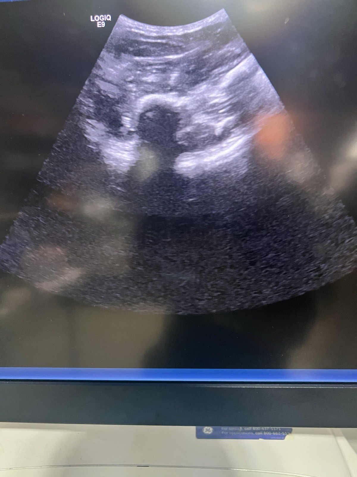 2017 GE LOGIQ E9 R6 Ultrasound | XDclear 2.0 |All Options | Warranty